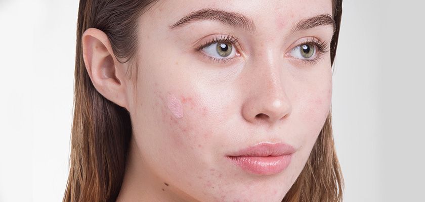 I brufoli non vanno più via? Scopri i rimedi migliori per l'acne