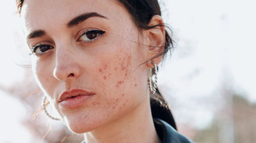 Brufoli a 40 anni? Scopri cause e rimedi per l'acne tardiva