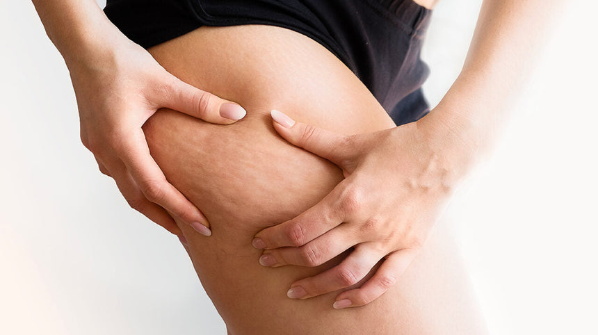 Cellulite: guida completa contro la pelle a buccia d'arancia