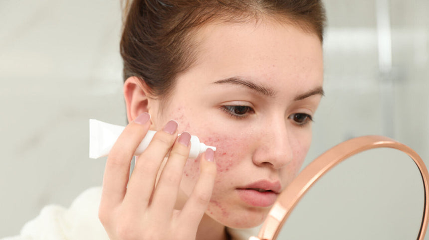 SOS acne: guida completa a cause, trattamenti, cure e rimedi